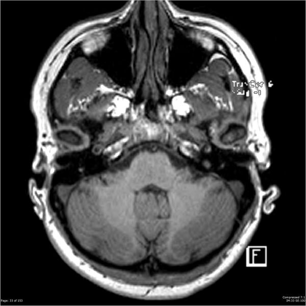 File:Cavernous malformation (cavernous angioma or cavernoma) (Radiopaedia 36675-38237 Axial T1 22).jpg