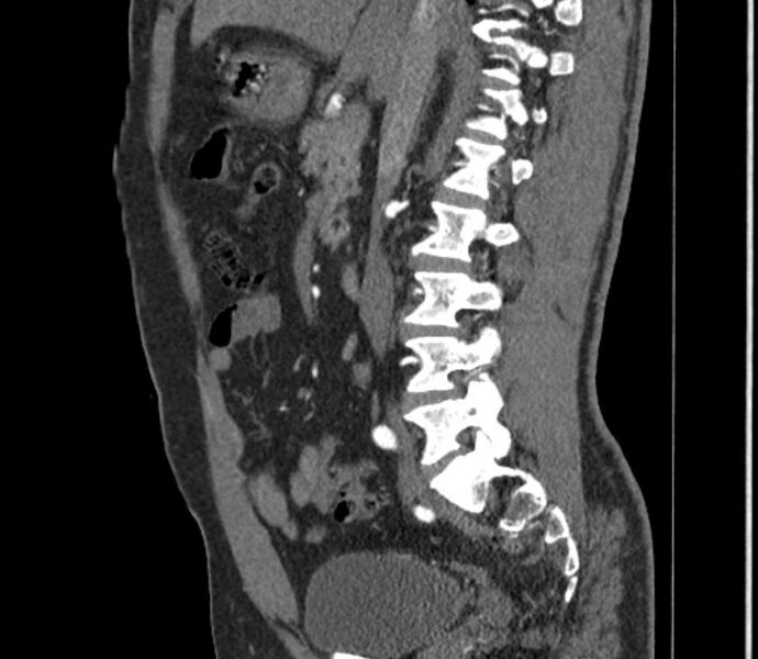 File:Celiac artery dissection (Radiopaedia 52194-58080 B 26).jpg