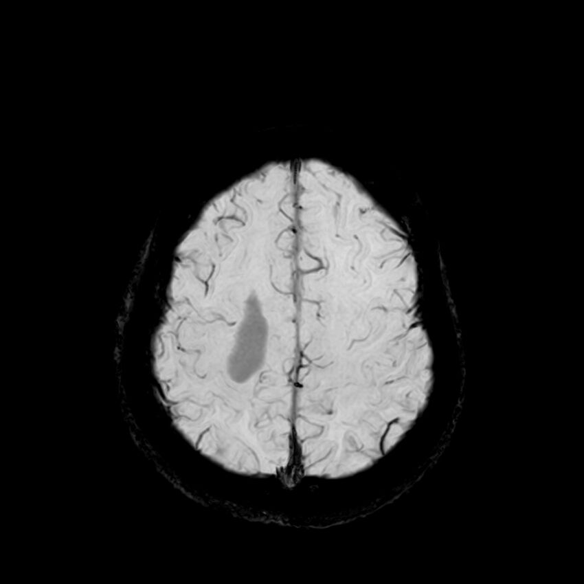 Central neurocytoma (Radiopaedia 79320-92380 Axial SWI 113).jpg