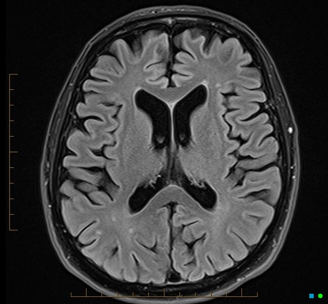 File:Cerebellar gangliocytoma (Radiopaedia 65377-74422 Axial FLAIR 22).jpg