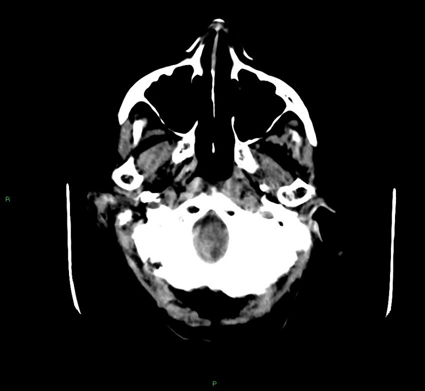 Cerebellar hemorrhage (Radiopaedia 58792-66026 Axial non-contrast 46).jpg