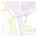 Cerebellar tonsillar position (illustration) (Radiopaedia 10769).jpg
