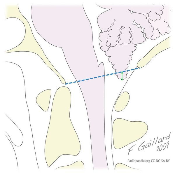 File:Cerebellar tonsillar position (illustration) (Radiopaedia 10769).jpg