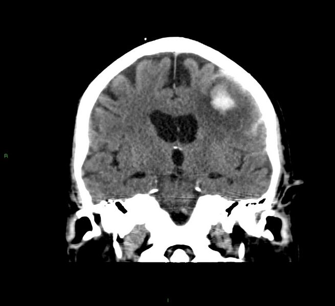 File:Cerebral amyloid angiopathy-associated lobar intracerebral hemorrhage (Radiopaedia 58376-65511 Coronal non-contrast 35).jpg