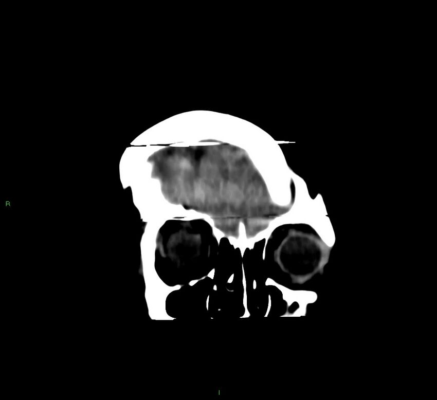 Cerebral amyloid angiopathy-associated lobar intracerebral hemorrhage (Radiopaedia 58377-65514 Coronal non-contrast 57).jpg