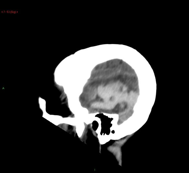 File:Cerebral amyloid angiopathy-associated lobar intracerebral hemorrhage (Radiopaedia 58378-65518 C 53).jpg