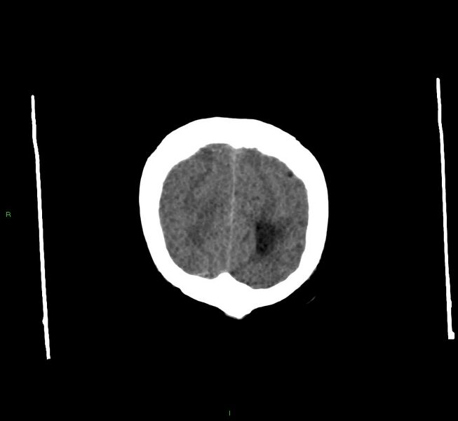 File:Cerebral amyloid angiopathy-associated lobar intracerebral hemorrhage (Radiopaedia 58560-65723 Coronal non-contrast 10).jpg