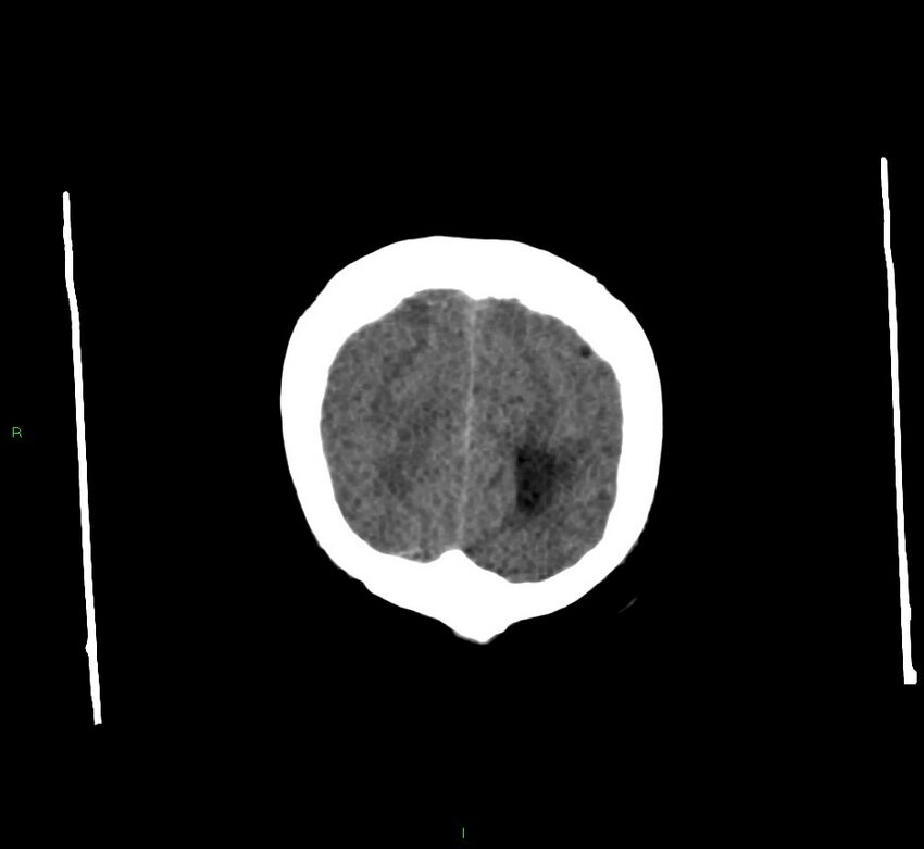 Cerebral amyloid angiopathy-associated lobar intracerebral hemorrhage (Radiopaedia 58560-65723 Coronal non-contrast 10).jpg