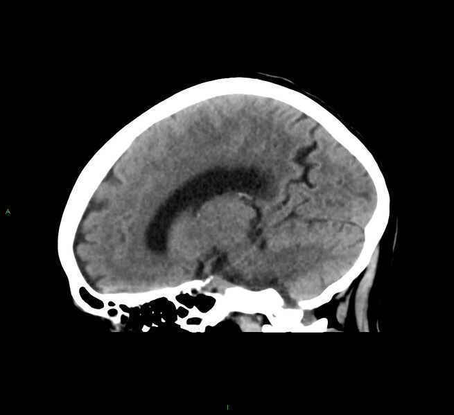 File:Cerebral amyloid angiopathy-associated lobar intracerebral hemorrhage (Radiopaedia 58563-65727 C 32).jpg