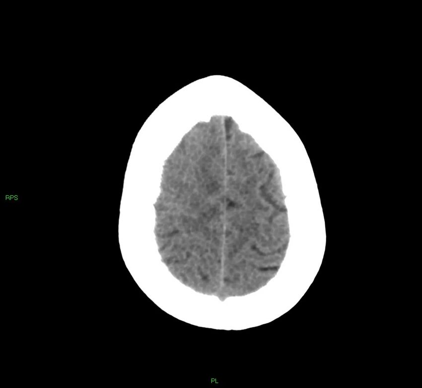 Cerebral amyloid angiopathy-associated lobar intracerebral hemorrhage (Radiopaedia 58569-65734 Axial non-contrast 16).jpg