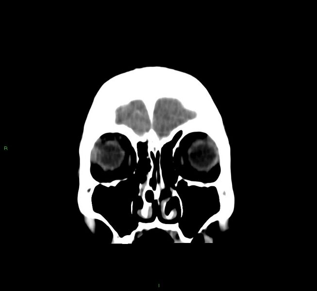 File:Cerebral amyloid angiopathy-associated lobar intracerebral hemorrhage (Radiopaedia 58751-65972 Coronal non-contrast 53).jpg
