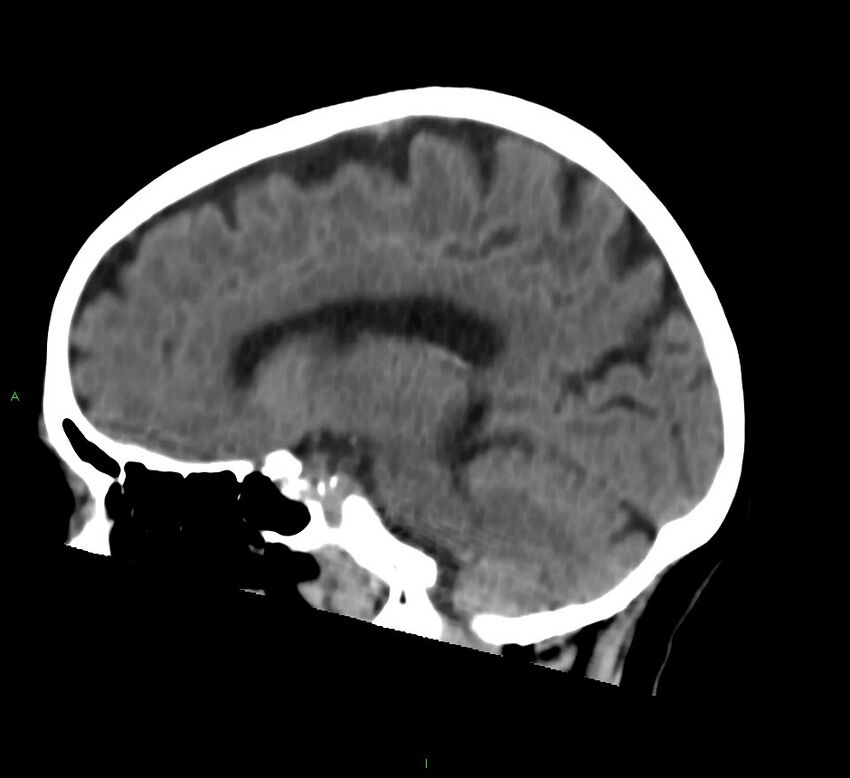 Cerebral amyloid angiopathy-associated lobar intracerebral hemorrhage (Radiopaedia 58757-65978 C 24).jpg