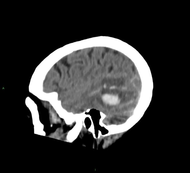 File:Cerebral amyloid angiopathy-associated lobar intracerebral hemorrhage (Radiopaedia 58757-65978 C 44).jpg