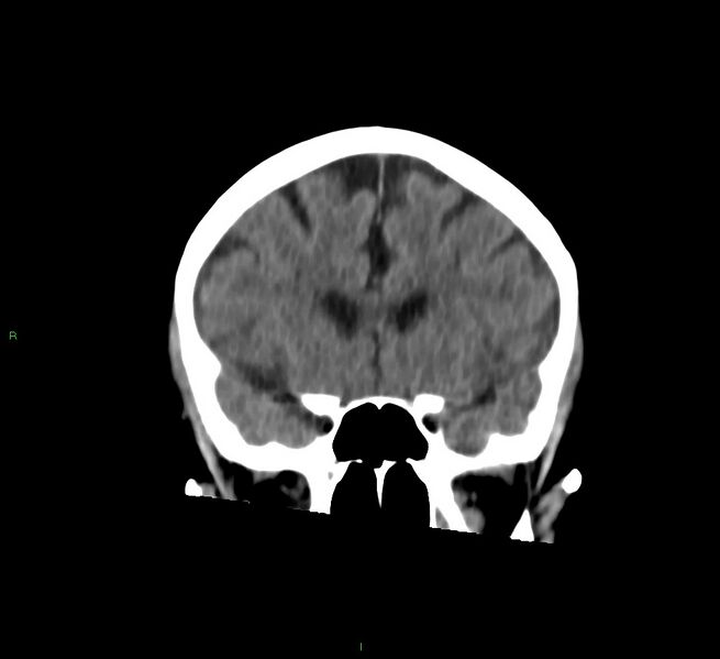 File:Cerebral amyloid angiopathy-associated lobar intracerebral hemorrhage (Radiopaedia 58757-65978 Coronal non-contrast 46).jpg
