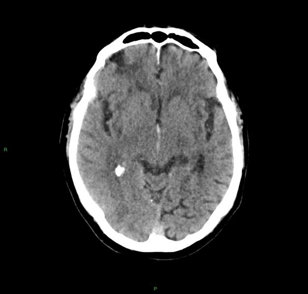 File:Cerebral amyloid angiopathy-associated lobar intracerebral hemorrhage (Radiopaedia 59356-66716 Axial non-contrast 27).jpg