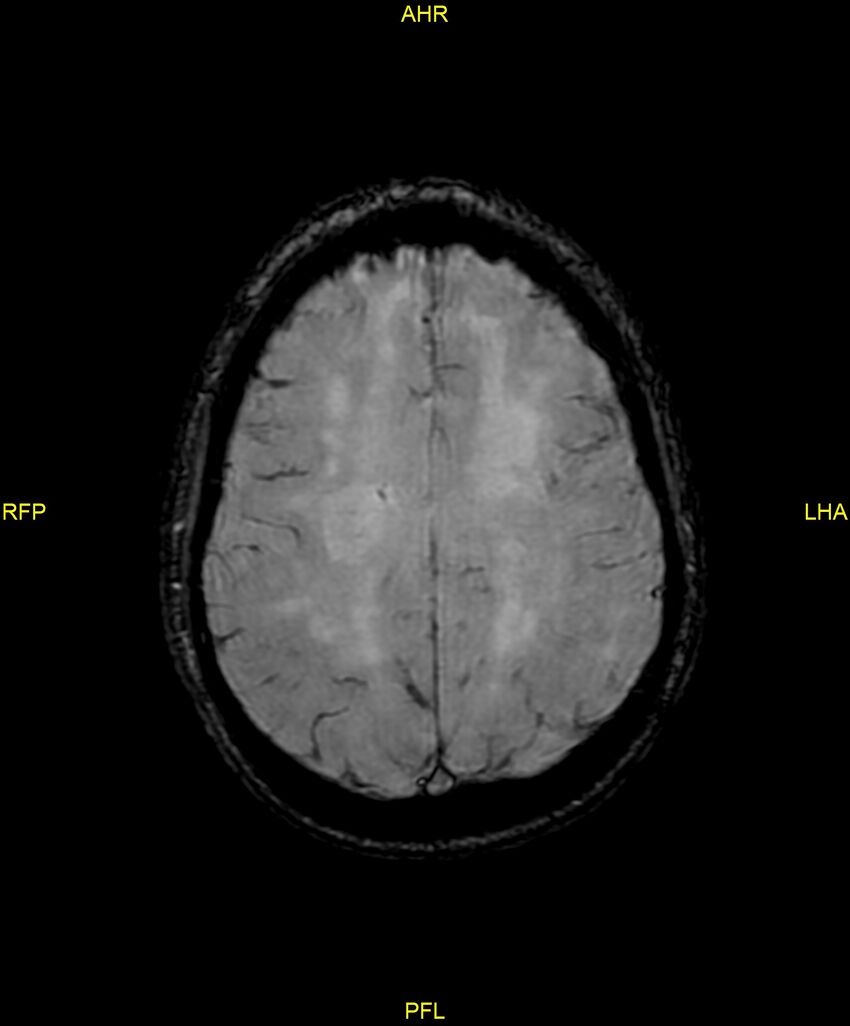 Cerebral autosomal dominant arteriopathy with subcortical infarcts and leukoencephalopathy (CADASIL) (Radiopaedia 86108-102054 Axial SWI 77).jpg