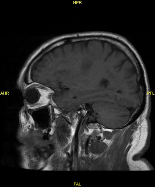 File:Cerebral autosomal dominant arteriopathy with subcortical infarcts and leukoencephalopathy (CADASIL) (Radiopaedia 86108-102054 Sagittal T1 9).jpg