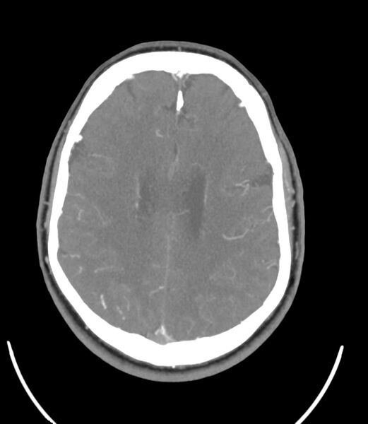 File:Cerebral dural venous sinus thrombosis (Radiopaedia 86514-102576 A 68).jpg
