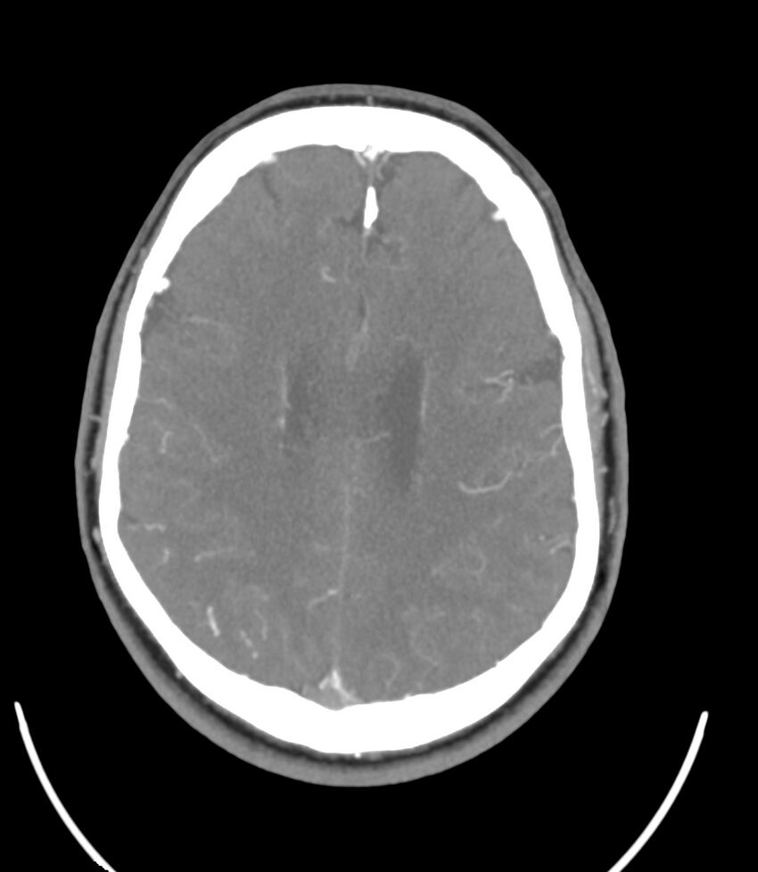 Cerebral dural venous sinus thrombosis (Radiopaedia 86514-102576 A 68).jpg