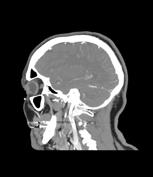 File:Cerebral dural venous sinus thrombosis (Radiopaedia 86514-102576 C 12).jpg