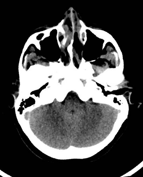 File:Cerebral edema due to severe hyponatremia (Radiopaedia 89826-106938 Axial non-contrast 24).jpg