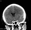 Cerebral hemorrhagic contusion with subdural and subarachnoid hemorrhage (Radiopaedia 10680-11146 Coronal non-contrast 8).jpg