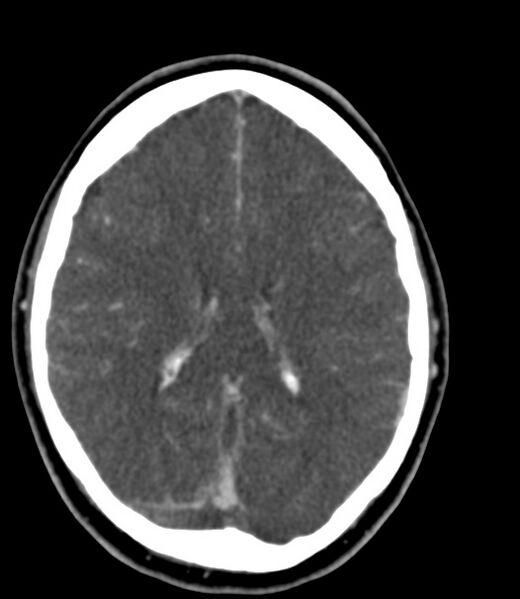 File:Cerebral venous sinus thrombosis (Radiopaedia 59224-66646 Axial C+ delayed 22).jpg
