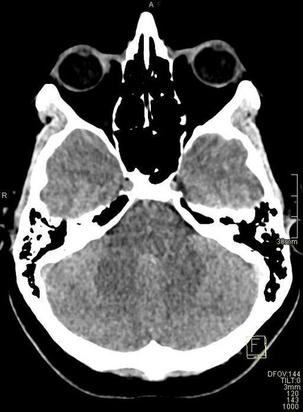 File:Cerebral venous sinus thrombosis (Radiopaedia 91329-108965 Axial non-contrast 14).jpg