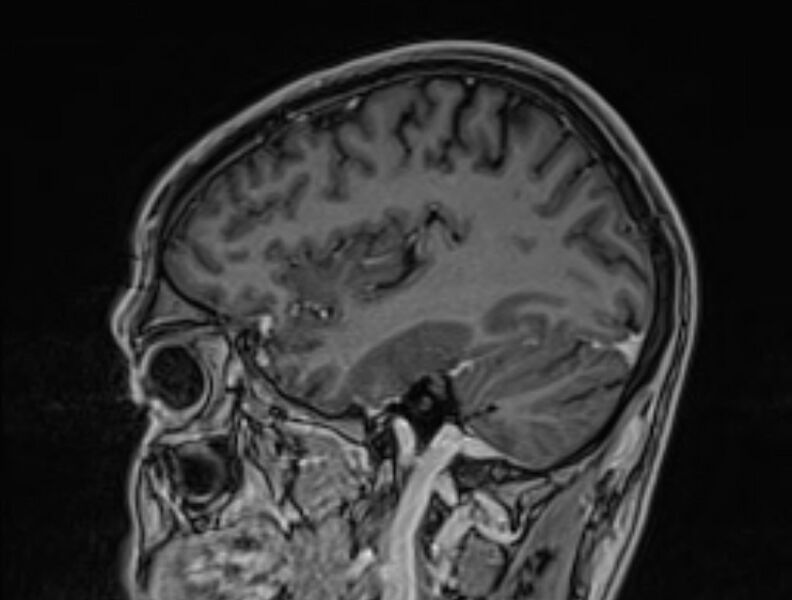 File:Cerebral venous thrombosis (Radiopaedia 71207-81504 Sagittal T1 C+ 14).jpg