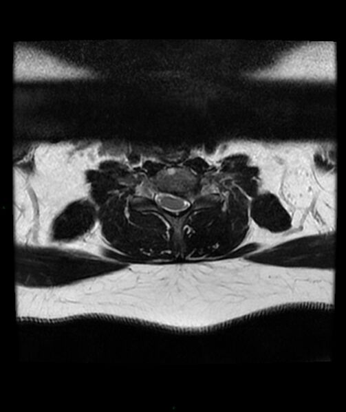 File:Cervical disc prolapse (Radiopaedia 80258-93598 Axial T2 52).jpg