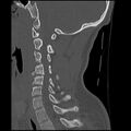 Cervical flexion teardrop fracture with cord hemorrhage (Radiopaedia 32497-33454 Sagittal bone window 27).jpg