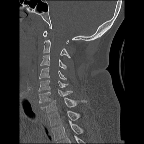 File:Cervical fracture and dislocation with locked facet (Radiopaedia 31837-32780 Sagittal bone window 19).jpg