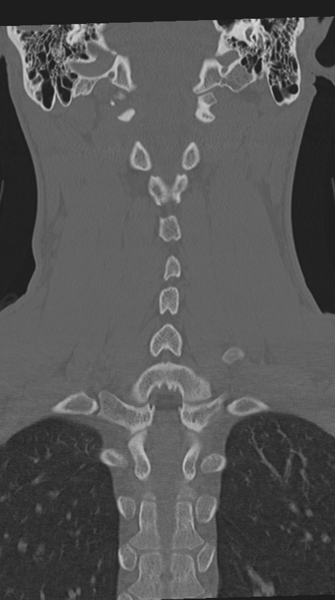 File:Cervical intercalary bone (Radiopaedia 35211-36748 Coronal bone window 50).png