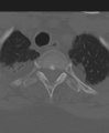 Cervical spine ACDF loosening (Radiopaedia 48998-54071 Axial bone window 59).png