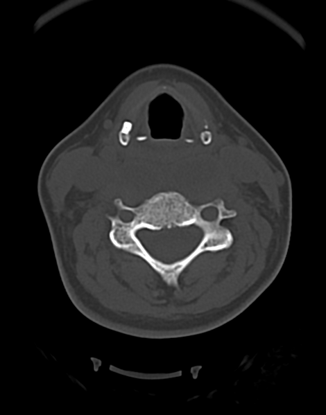 File:Cervical tuberculous spondylitis (Radiopaedia 39149-41365 Axial bone window 27).png