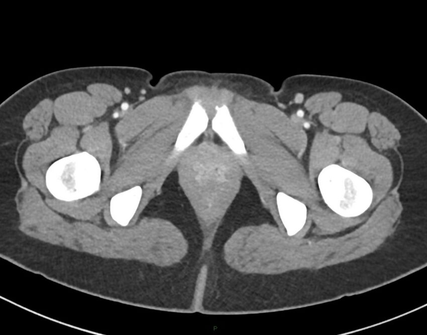 Cesarean scar endometriosis (Radiopaedia 82925-97262 A 91).jpg