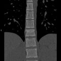 Chance fracture (Radiopaedia 36521-38081 Coronal bone window 10).jpg