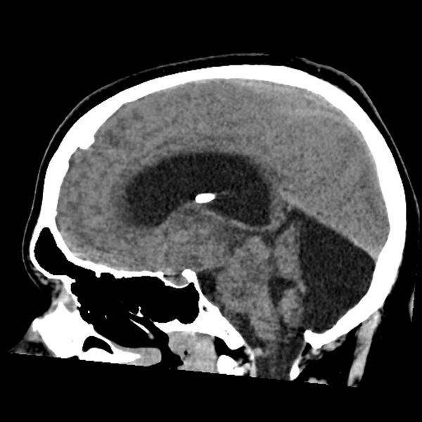 File:Chiasmatic-hypothalamic juvenile pilocytic astrocytoma (Radiopaedia 78533-91237 B 31).jpg