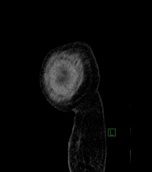File:Cholangiocarcinoma with cerebral metastases (Radiopaedia 83519-98629 F 6).jpg