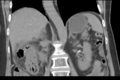 Cholecystitis - CT IVC obstructive choledocholitiasis (Radiopaedia 43966-47479 Coronal Biliscopin 31).png