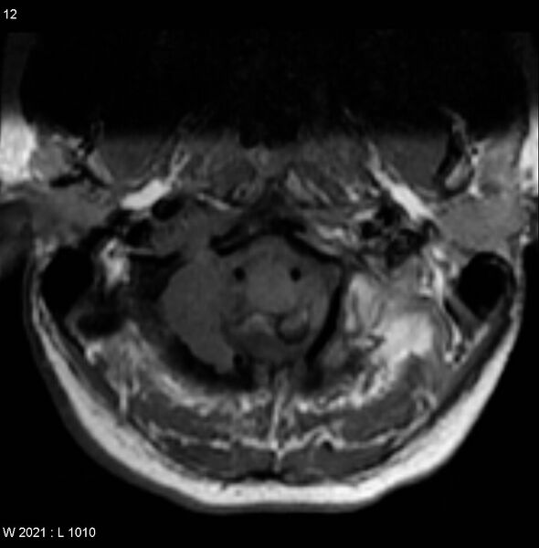 File:Chondroblastoma - occipital condyle (Radiopaedia 5569-7306 Axial T1 1).jpg