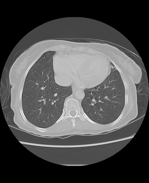 File:Chondrosarcoma (Radiopaedia 79427-92532 Axial lung window 41).jpg