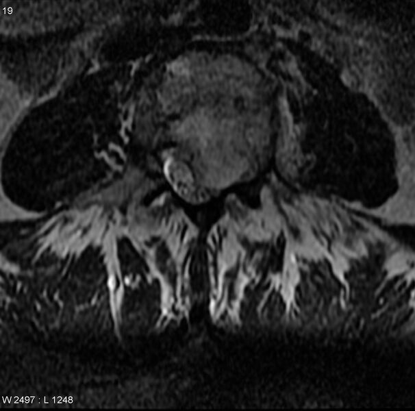 File:Chondrosarcoma - clear cell (Radiopaedia 6176-7635 Axial T2 1).jpg
