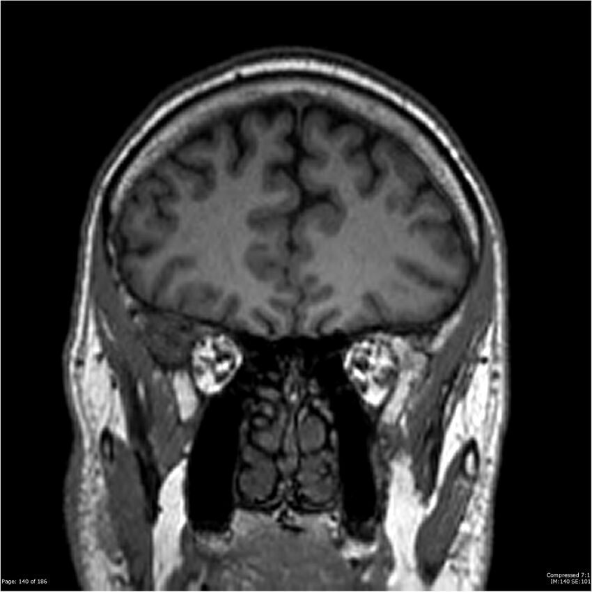 Chondrosarcoma of skull base- grade II (Radiopaedia 40948-43654 Coronal T1 61).jpg