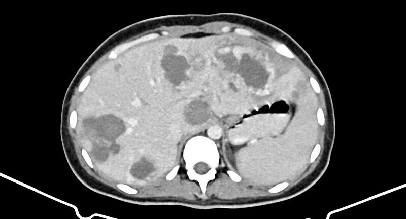 File:Choriocarcinoma liver metastases (Radiopaedia 74768-85766 A 55).jpg