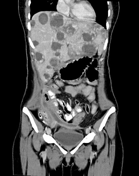 File:Choriocarcinoma liver metastases (Radiopaedia 74768-85766 B 38).jpg