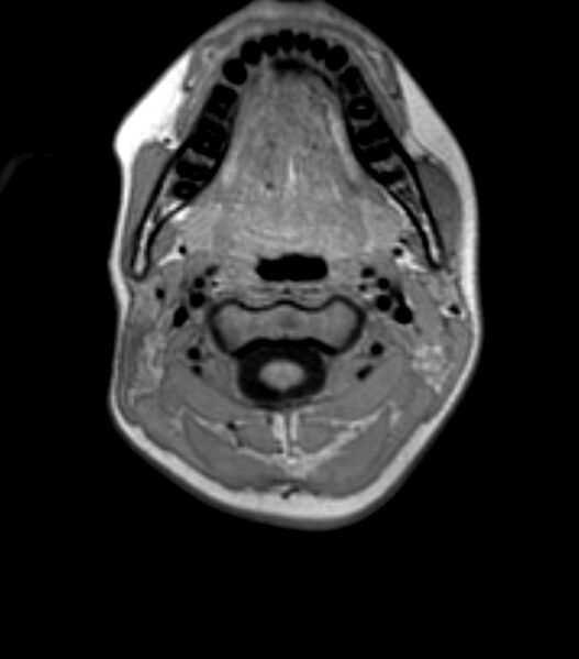 File:Choroid plexus carcinoma (Radiopaedia 91013-108553 Axial T1 2).jpg