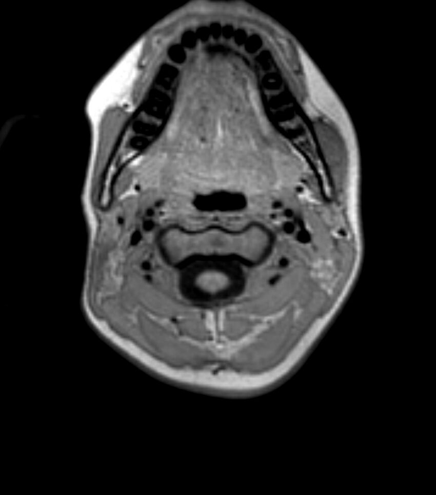 Choroid plexus carcinoma (Radiopaedia 91013-108553 Axial T1 2).jpg