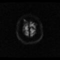 Choroid plexus xanthogranuloma (Radiopaedia 17650-17386 DWI 1).jpg