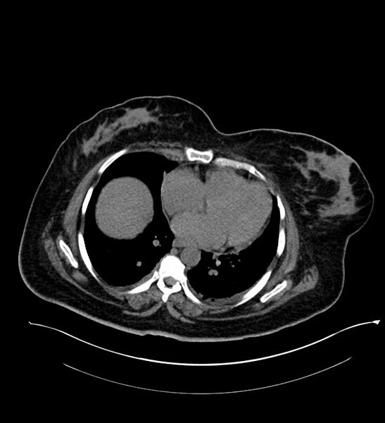 File:Chromophobe renal cell carcinoma (Radiopaedia 84239-99519 Axial non-contrast 15).jpg